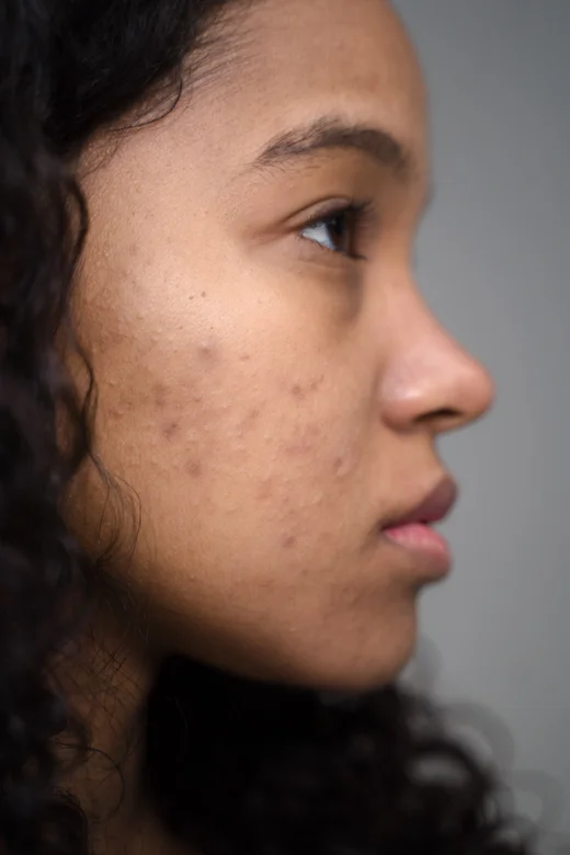 Tratamento de Acne