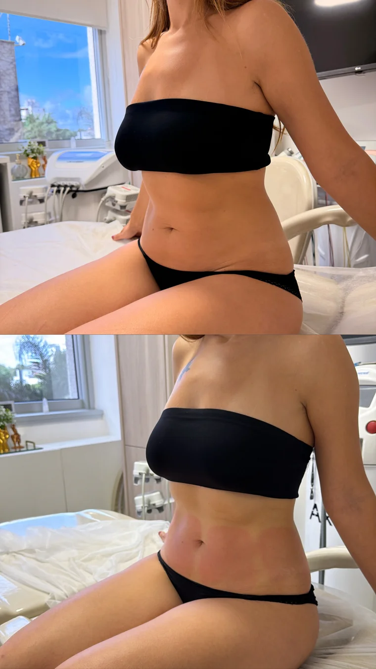 Antes e depois — Pós-imediato