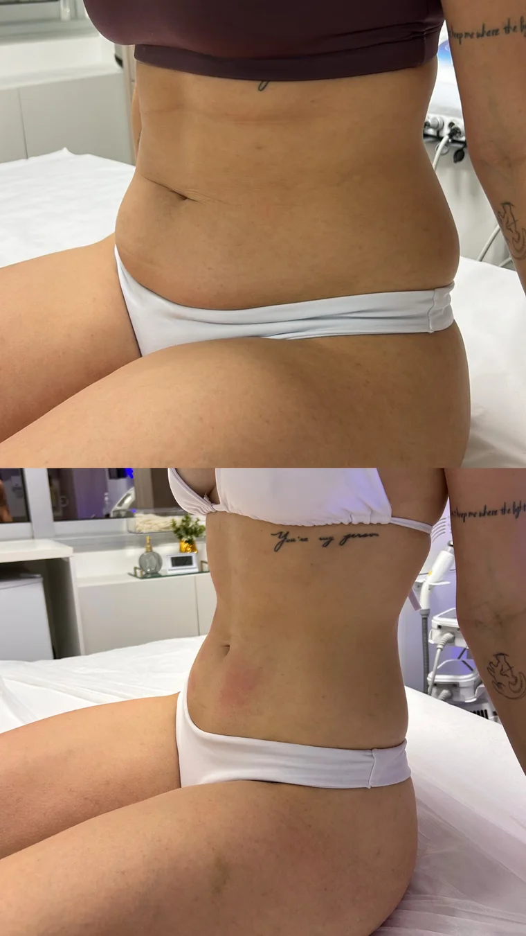 Antes e depois — Criolipólise