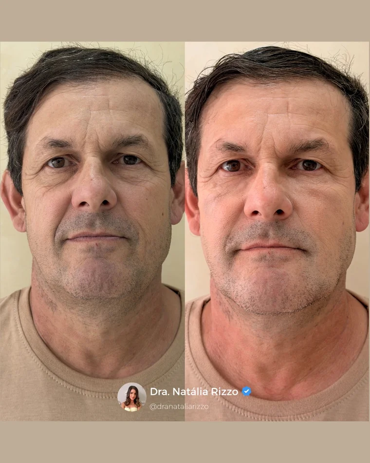Antes e depois — Harmonização facial