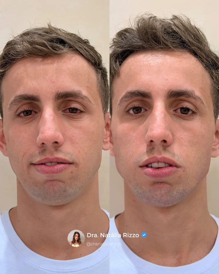 Antes e depois — Harmonização facial completa