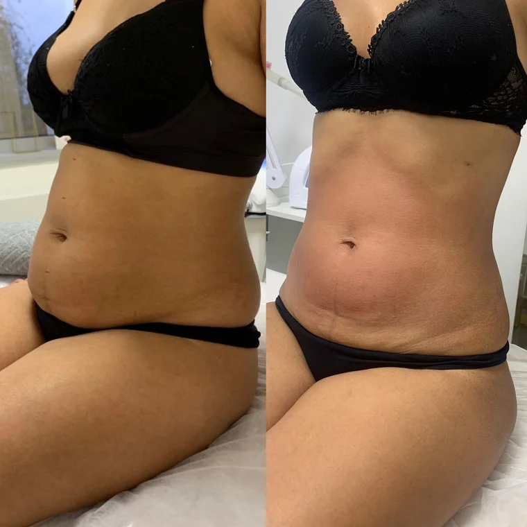 Antes e depois — 10 sessões