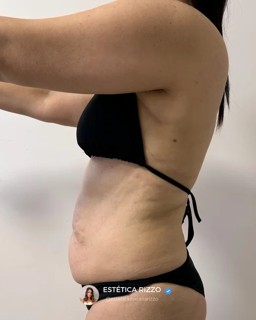 Lipo sem Corte