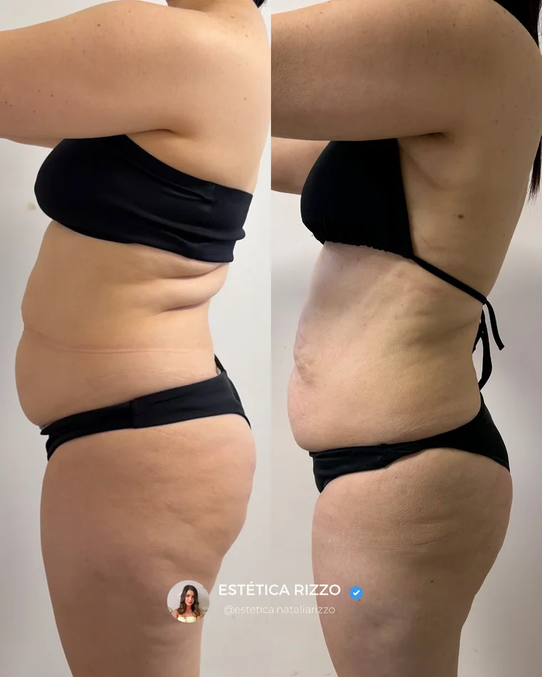 Antes e depois — Lipo sem Corte