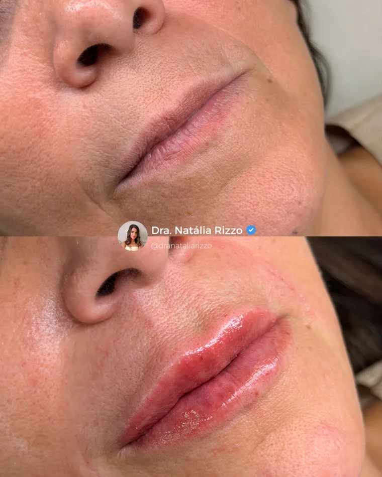 Antes e depois — Preenchimento labial